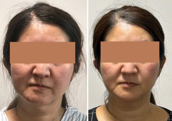顎変形症手術 顔の変化　アラ50